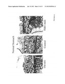 DIAGNOSIS AND TREATMENT OF NEUROECTODERMAL TUMORS diagram and image