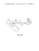 DEVICES AND METHODS FOR TISSUE MODIFICATION diagram and image