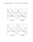 DEVICES AND METHODS FOR TISSUE MODIFICATION diagram and image