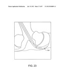 DEVICES AND METHODS FOR TISSUE MODIFICATION diagram and image