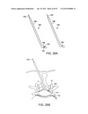 DEVICES AND METHODS FOR TISSUE MODIFICATION diagram and image