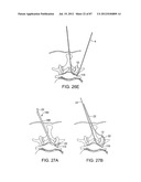 DEVICES AND METHODS FOR TISSUE MODIFICATION diagram and image