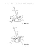 DEVICES AND METHODS FOR TISSUE MODIFICATION diagram and image