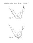 DEVICES AND METHODS FOR TISSUE MODIFICATION diagram and image