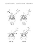 DEVICES AND METHODS FOR TISSUE MODIFICATION diagram and image