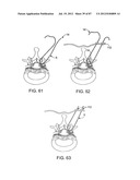 DEVICES AND METHODS FOR TISSUE MODIFICATION diagram and image