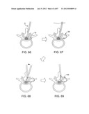 DEVICES AND METHODS FOR TISSUE MODIFICATION diagram and image