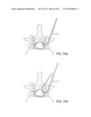 DEVICES AND METHODS FOR TISSUE MODIFICATION diagram and image