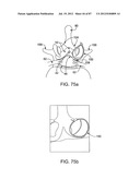 DEVICES AND METHODS FOR TISSUE MODIFICATION diagram and image