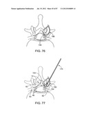 DEVICES AND METHODS FOR TISSUE MODIFICATION diagram and image