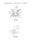 DEVICES AND METHODS FOR TISSUE MODIFICATION diagram and image