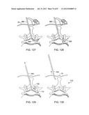 DEVICES AND METHODS FOR TISSUE MODIFICATION diagram and image