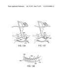 DEVICES AND METHODS FOR TISSUE MODIFICATION diagram and image