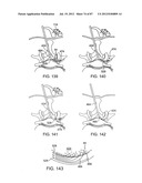 DEVICES AND METHODS FOR TISSUE MODIFICATION diagram and image