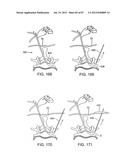 DEVICES AND METHODS FOR TISSUE MODIFICATION diagram and image