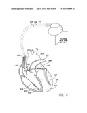 SYSTEMS AND METHODS FOR CORROBORATING IMPEDANCE-BASED LEFT ATRIAL PRESSURE     (LAP) ESTIMATES FOR USE BY AN IMPLANTABLE MEDICAL DEVICE diagram and image