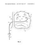 SYSTEMS, DEVICES AND METHODS FOR TREATING THE HEART WITH ABLATION diagram and image