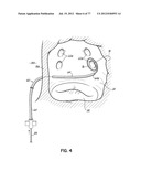 SYSTEMS, DEVICES AND METHODS FOR TREATING THE HEART WITH ABLATION diagram and image