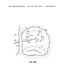 SYSTEMS, DEVICES AND METHODS FOR TREATING THE HEART WITH ABLATION diagram and image