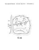 SYSTEMS, DEVICES AND METHODS FOR TREATING THE HEART WITH ABLATION diagram and image