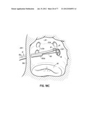 SYSTEMS, DEVICES AND METHODS FOR TREATING THE HEART WITH ABLATION diagram and image