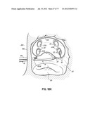 SYSTEMS, DEVICES AND METHODS FOR TREATING THE HEART WITH ABLATION diagram and image