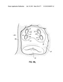 SYSTEMS, DEVICES AND METHODS FOR TREATING THE HEART WITH ABLATION diagram and image