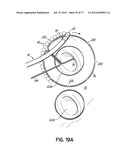 SYSTEMS, DEVICES AND METHODS FOR TREATING THE HEART WITH ABLATION diagram and image