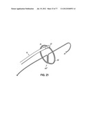 SYSTEMS, DEVICES AND METHODS FOR TREATING THE HEART WITH ABLATION diagram and image