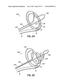 SYSTEMS, DEVICES AND METHODS FOR TREATING THE HEART WITH ABLATION diagram and image