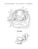 SYSTEMS, DEVICES AND METHODS FOR TREATING THE HEART WITH ABLATION diagram and image