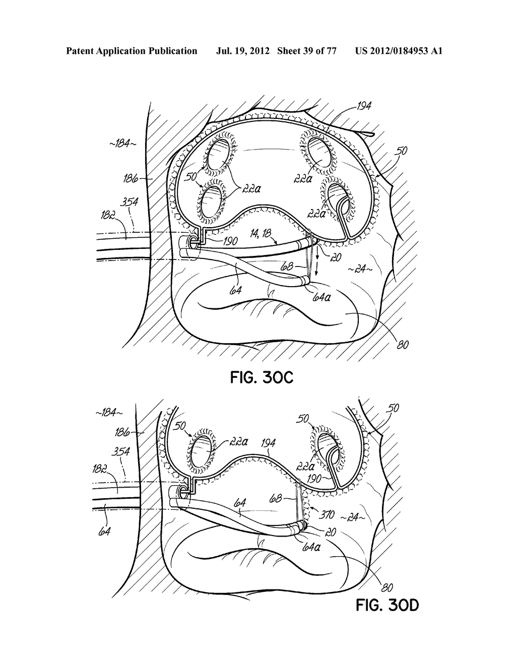 SYSTEMS, DEVICES AND METHODS FOR TREATING THE HEART WITH ABLATION - diagram, schematic, and image 40