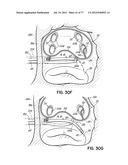 SYSTEMS, DEVICES AND METHODS FOR TREATING THE HEART WITH ABLATION diagram and image