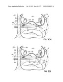 SYSTEMS, DEVICES AND METHODS FOR TREATING THE HEART WITH ABLATION diagram and image