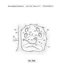 SYSTEMS, DEVICES AND METHODS FOR TREATING THE HEART WITH ABLATION diagram and image