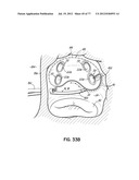 SYSTEMS, DEVICES AND METHODS FOR TREATING THE HEART WITH ABLATION diagram and image