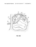 SYSTEMS, DEVICES AND METHODS FOR TREATING THE HEART WITH ABLATION diagram and image