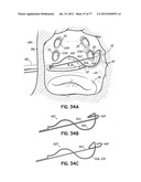 SYSTEMS, DEVICES AND METHODS FOR TREATING THE HEART WITH ABLATION diagram and image