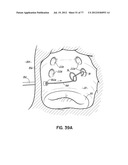 SYSTEMS, DEVICES AND METHODS FOR TREATING THE HEART WITH ABLATION diagram and image