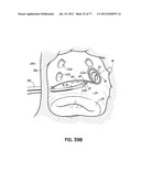 SYSTEMS, DEVICES AND METHODS FOR TREATING THE HEART WITH ABLATION diagram and image