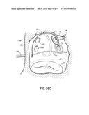 SYSTEMS, DEVICES AND METHODS FOR TREATING THE HEART WITH ABLATION diagram and image