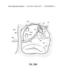 SYSTEMS, DEVICES AND METHODS FOR TREATING THE HEART WITH ABLATION diagram and image