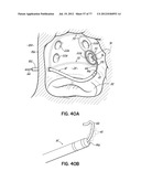 SYSTEMS, DEVICES AND METHODS FOR TREATING THE HEART WITH ABLATION diagram and image