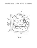 SYSTEMS, DEVICES AND METHODS FOR TREATING THE HEART WITH ABLATION diagram and image