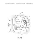 SYSTEMS, DEVICES AND METHODS FOR TREATING THE HEART WITH ABLATION diagram and image