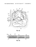 SYSTEMS, DEVICES AND METHODS FOR TREATING THE HEART WITH ABLATION diagram and image