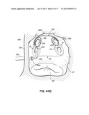 SYSTEMS, DEVICES AND METHODS FOR TREATING THE HEART WITH ABLATION diagram and image