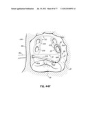 SYSTEMS, DEVICES AND METHODS FOR TREATING THE HEART WITH ABLATION diagram and image