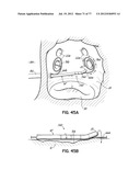 SYSTEMS, DEVICES AND METHODS FOR TREATING THE HEART WITH ABLATION diagram and image