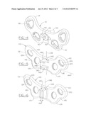 Wedge opening osteotomy plate diagram and image